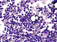 Peripheral T-cell lymphoma, unspecified bone marrow aspirate - 1.