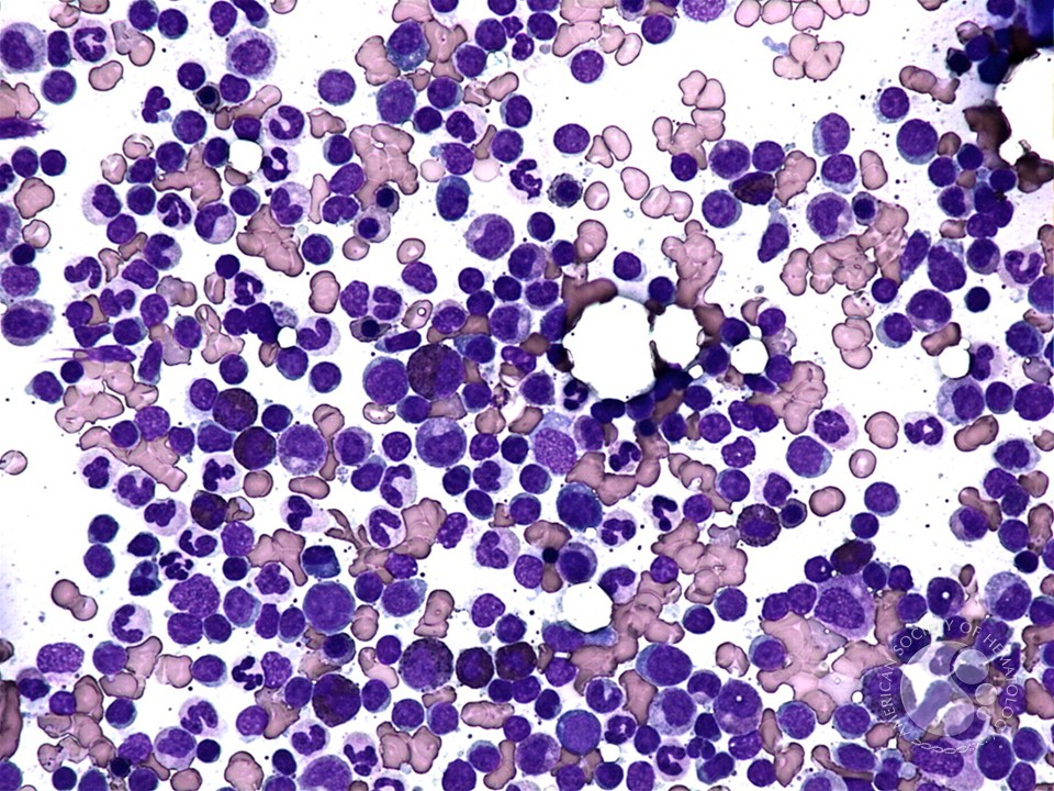 Peripheral T-cell lymphoma, unspecified bone marrow aspirate - 1.