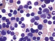 Peripheral Tcell lymphoma, unspecified bone marrow