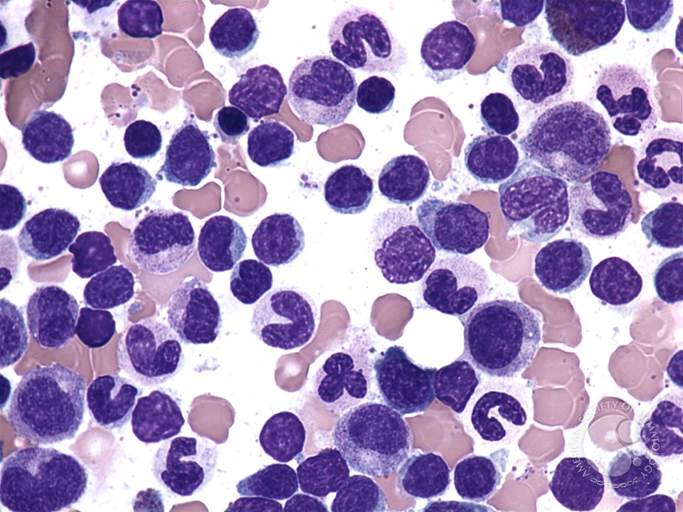 Peripheral T-cell lymphoma, unspecified bone marrow aspirate - 2.