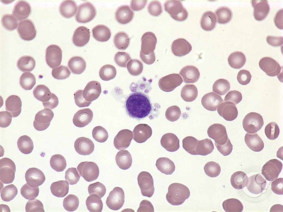Megakaryocyte-peripheral blood - 1.