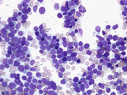 Precursor T-cell lymphoblastic leukemia - 1.