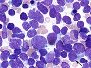 Precursor T-cell lymphoblastic leukemia - 2.