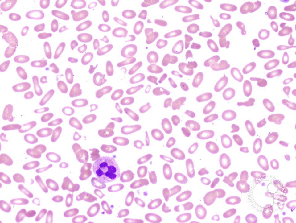 Hereditary pyropoikilocytosis - 1.