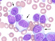 atypical-chronic-lymphocytic-leukemia-2