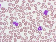 Adult T-cell leukemia/lymphoma, smoldering variant - 3.