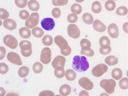 Adult T-cell leukemia/lymphoma, smoldering variant - 4.