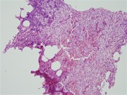 Indolent systemic mastocytosis - 1.