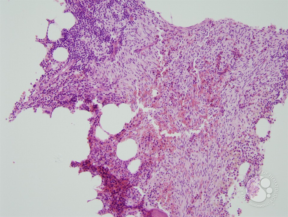 Indolent systemic mastocytosis - 1.