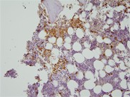 Indolent systemic mastocytosis - 3.