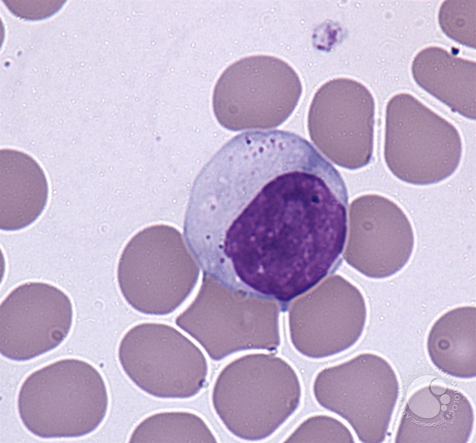 Large granular lymphocytes - 1.