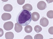 atypical-lymphocytes-1