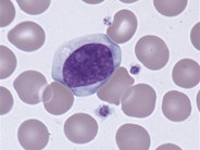 what are atypical lymphocytes