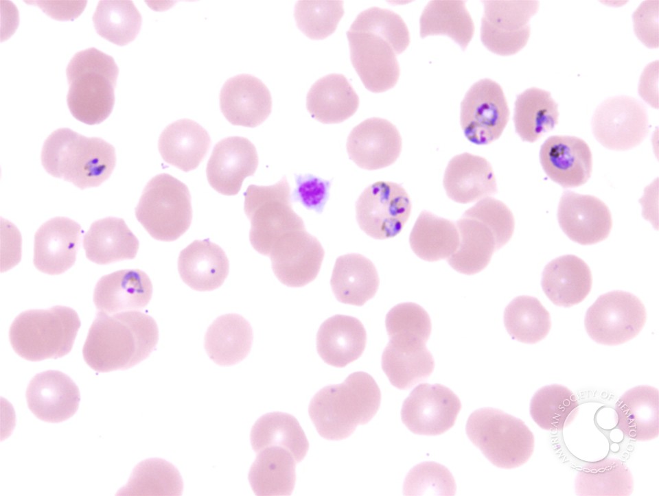 Plasmodium falciparum infection - 2.