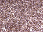 Extramedullary plasmacytomas - 4.