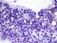 marrow bone normal aspirate adult study board hematology cells disorders blood crystals