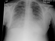 Transfusion Related Acute Lung Injury (TRALI) - 1.