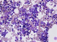 reactive lymphoid hyperplasia icd 10