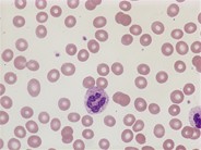 Normochromic normocytic anemia - 1.