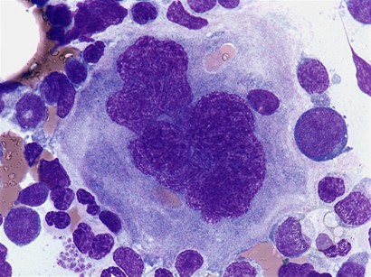 Giant megakayocyte - 1.