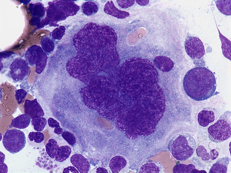 Giant megakayocyte - 1.
