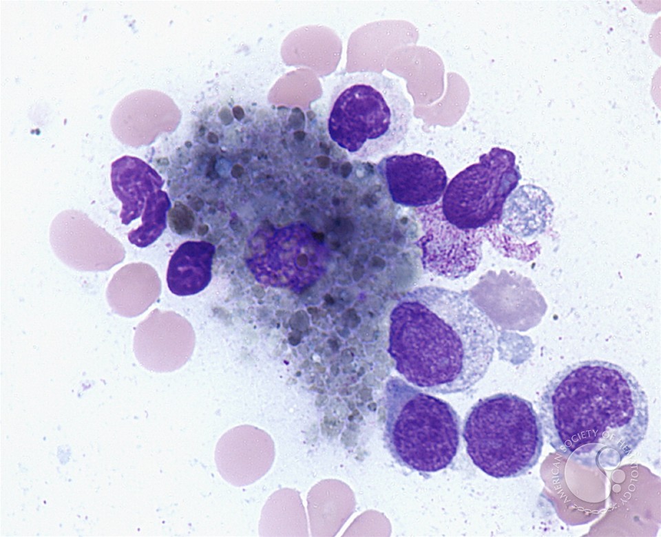 Histiocyte - 1.