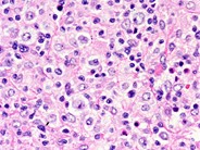 Diffuse large Bcell lymphoma, Tcell/histiocyte rich