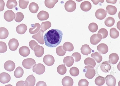 Lymphoplasmacytoid lymphocyte - 1.