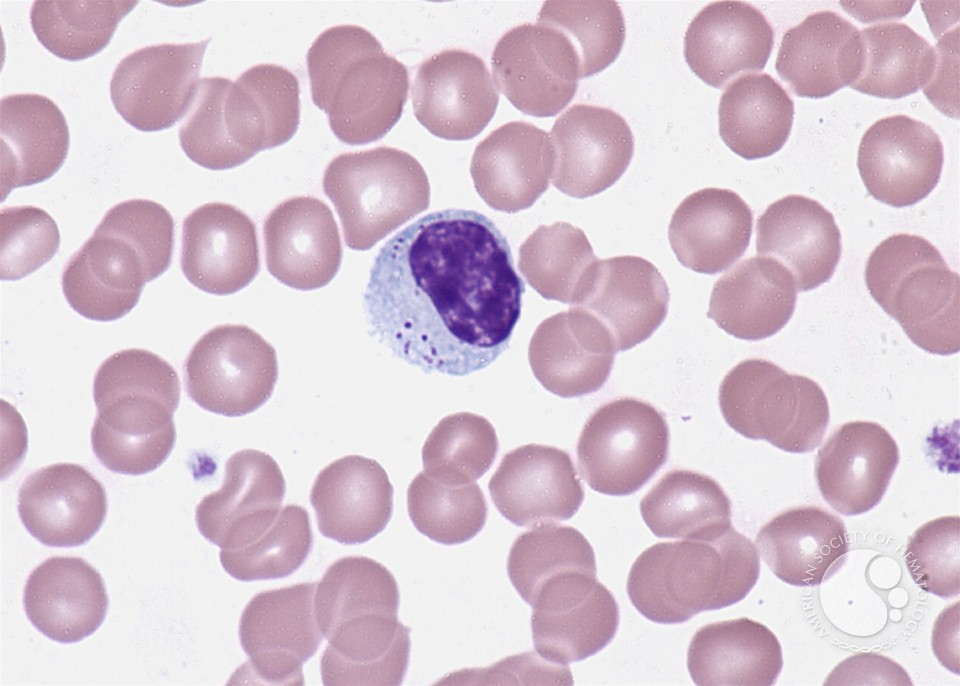 Large granular lymphocyte - 1.