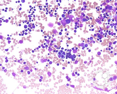 Hematophagocytic lymphohistiocytosis (HLH) in a patient with CLL - 1.