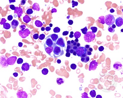 Hematophagocytic lymphohistiocytosis (HLH) in a patient with CLL - 2.