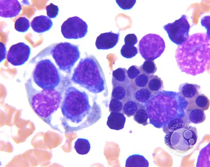 Hematophagocytic lymphohistiocytosis (HLH) in a patient with CLL - 3.