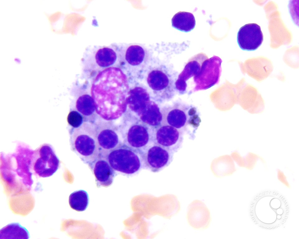 Hematophagocytic lymphohistiocytosis (HLH) in a patient with CLL - 5.
