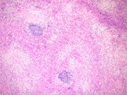 Systemic mastocytosis involving lymph nodes - 1.