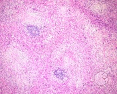 Systemic mastocytosis involving lymph nodes - 1.