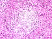 Systemic mastocytosis involving lymph nodes - 2.