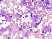 Bone marrow involvement in Niemann Pick disease - 1.