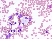 Bone marrow involvement in Niemann Pick disease - 2.