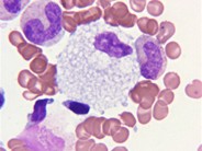 Bone marrow involvement in Niemann Pick disease 4.