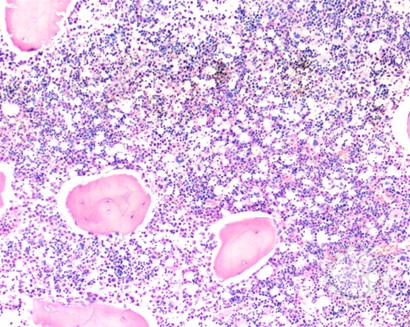 Bone marrow involvement in Niemann Pick disease - 5.