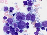 diffuse-large-b-cell-lymphoma-bone-marrow-aspirate-1