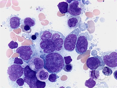 Diffuse large B-cell lymphoma - bone marrow aspirate - 1.