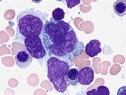 Diffuse large Bcell lymphoma bone marrow aspirate 2.