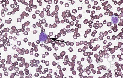 Diffuse large B-cell lymphoma - bone marrow aspirate - 3.
