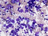 Diffuse large Bcell lymphoma bone marrow aspirate 4.