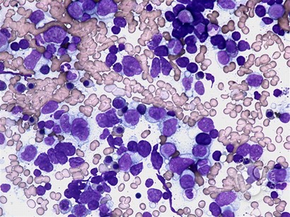 Diffuse large B-cell lymphoma - bone marrow aspirate - 4.