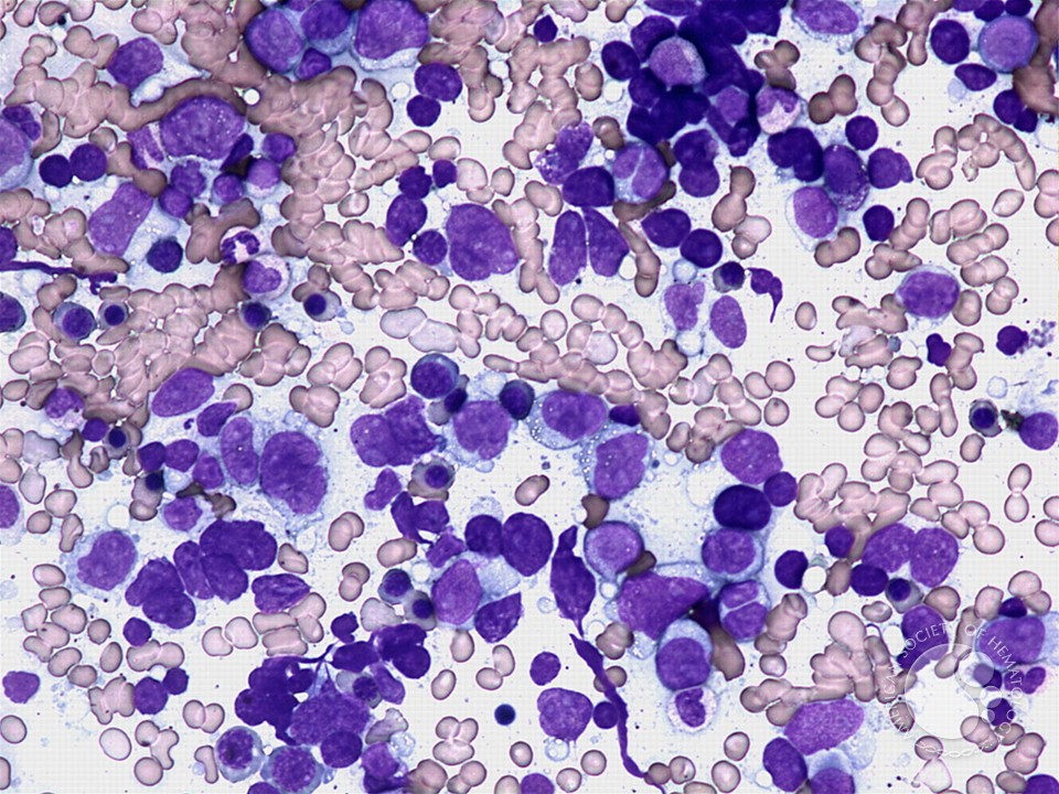 Diffuse large B-cell lymphoma - bone marrow aspirate - 4.
