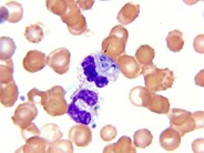 Bone marrow granulomas secondary to Histoplasmosis sepsis - 2.