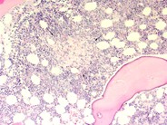 Bone marrow granulomas secondary to Histoplasmosis sepsis - 3.