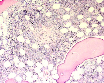 Bone marrow granulomas secondary to Histoplasmosis sepsis - 3.